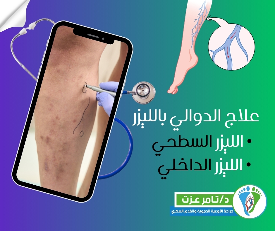 علاج الدوالي بالليزر السطحي