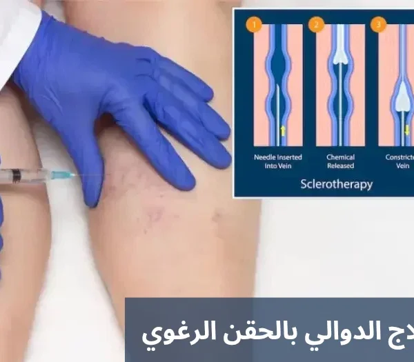 علاج الدوالي بالحقن الرغوي 20250206 213117 0000