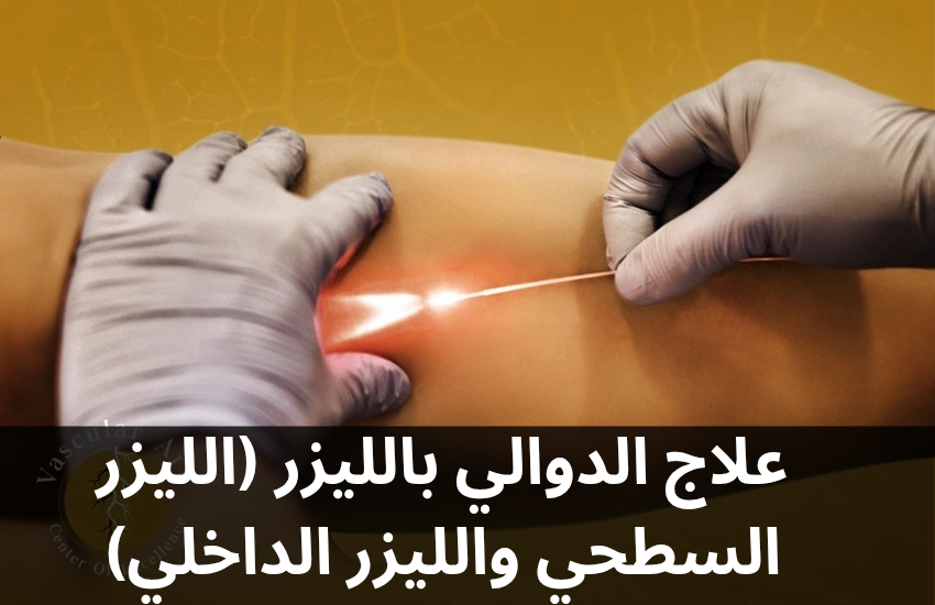 علاج الدوالي بالليزر الليزر السطحي والليزر الداخلي 20250209 191539 0000