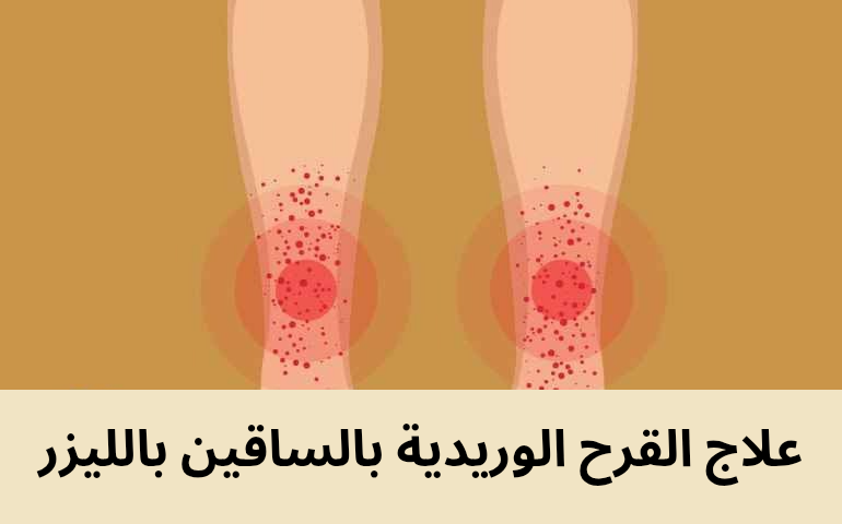 علاج القرح الوريدية بالساقين بالليزر 20250227 213947 0000