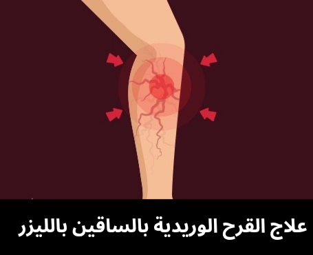 علاج القرح الوريدية بالساقين بالليزر 20250227 214315 0000