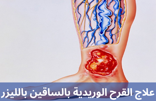 علاج القرح الوريدية بالساقين بالليزر 20250227 214548 0000