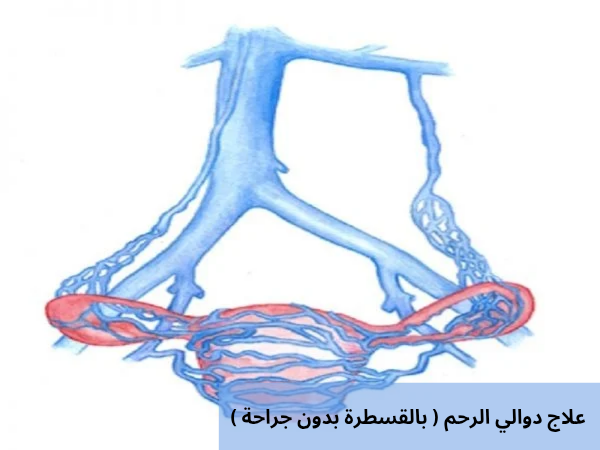 علاج دوالي الرحم بالقسطرة بدون جراحة 20250212 224850 0000