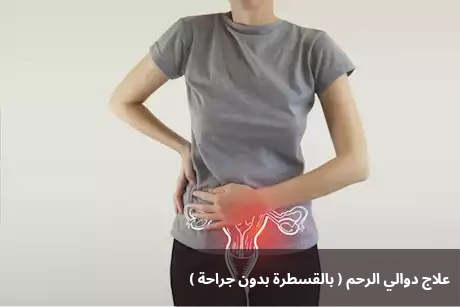 علاج دوالي الرحم بالقسطرة بدون جراحة 20250212 225202 0000