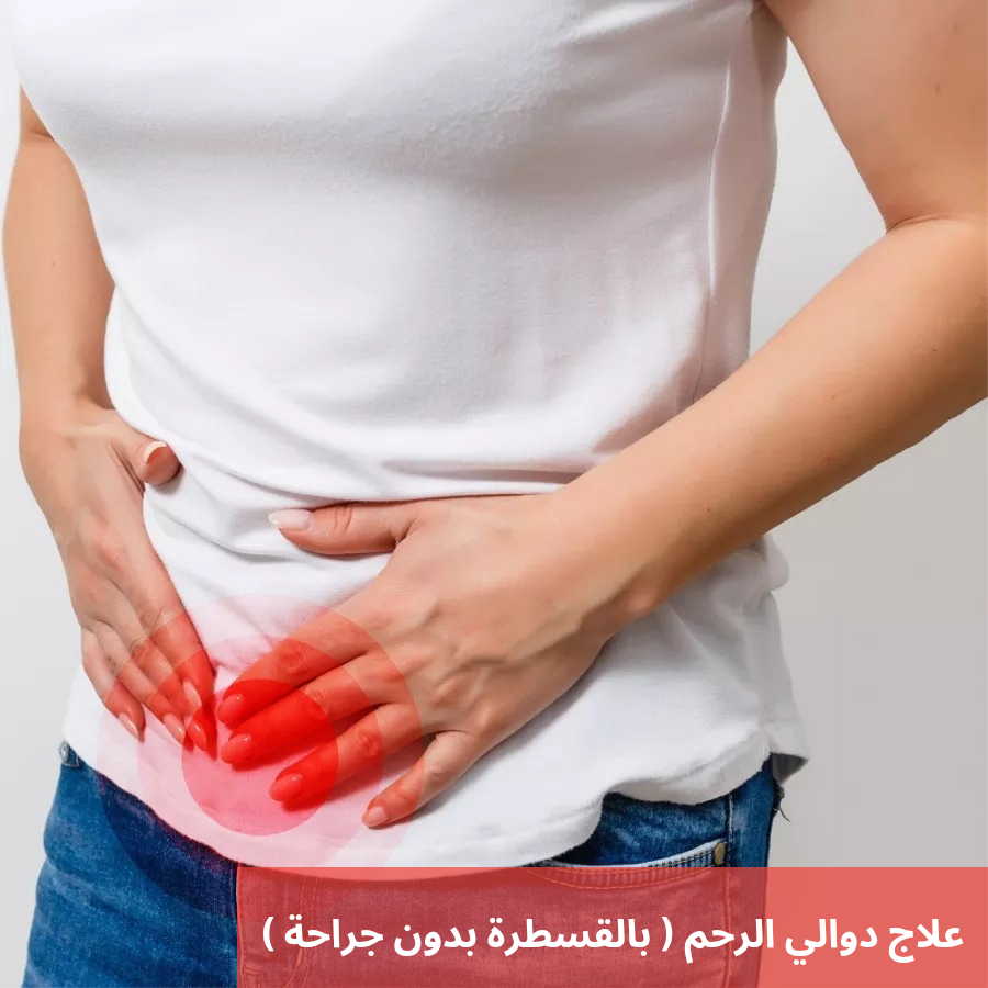 علاج دوالي الرحم بالقسطرة بدون جراحة 20250212 225358 0000