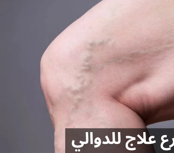 أسرع علاج للدوالي 20250327 133320 0000