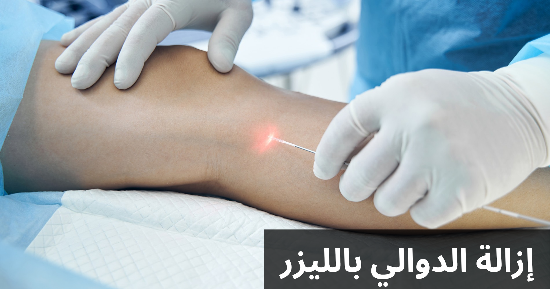 إزالة الدوالي بالليزر 20250323 132922 0000