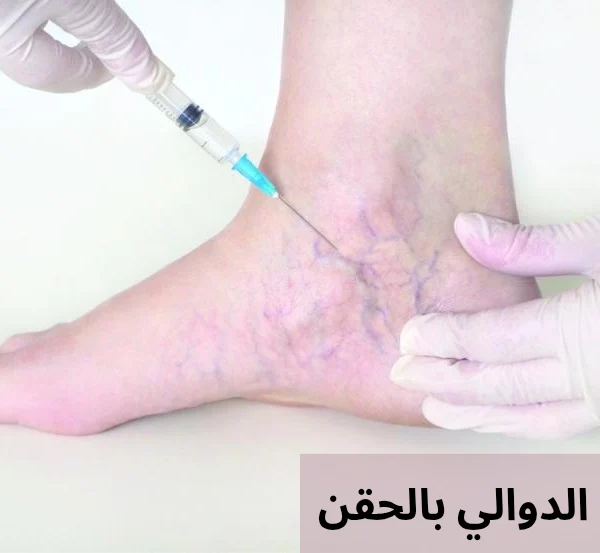 علاج الدوالي بالحقن 20250326 003426 0000