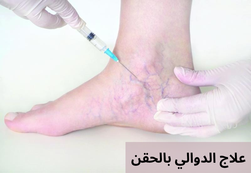 علاج الدوالي بالحقن 20250326 003426 0000