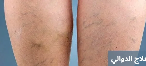 علاج الدوالي 20250318 023531 0000