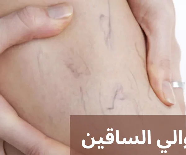 علاج دوالي الساقين 20250321 213204 0000
