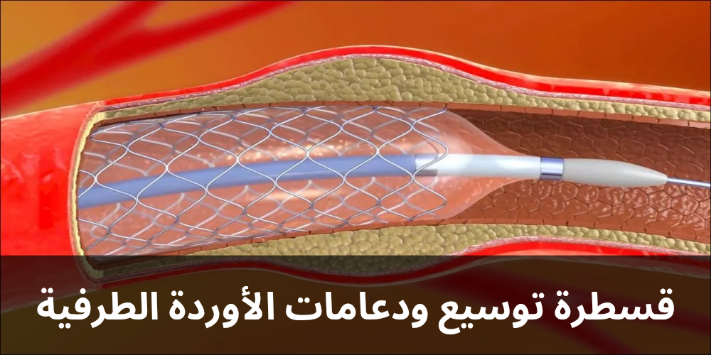 قسطرة توسيع ودعامات الأوردة الطرفية 20250303 235513 0000