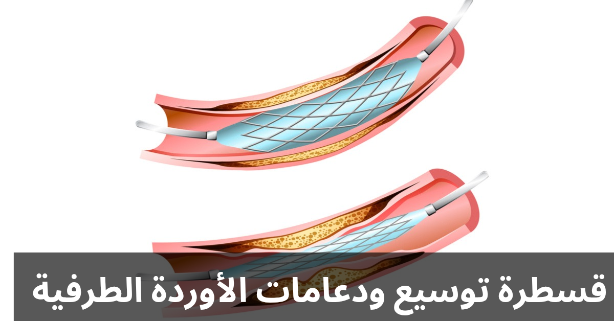 قسطرة توسيع ودعامات الأوردة الطرفية 20250303 235637 0000