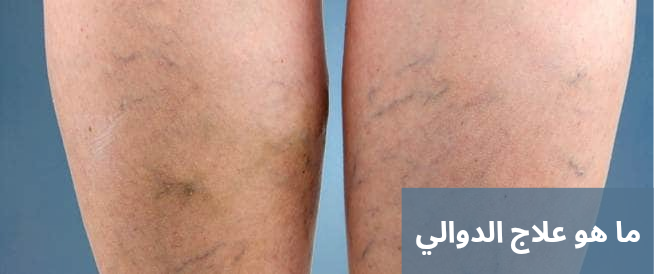 ما هو علاج الدوالي 20250324 214137 0000