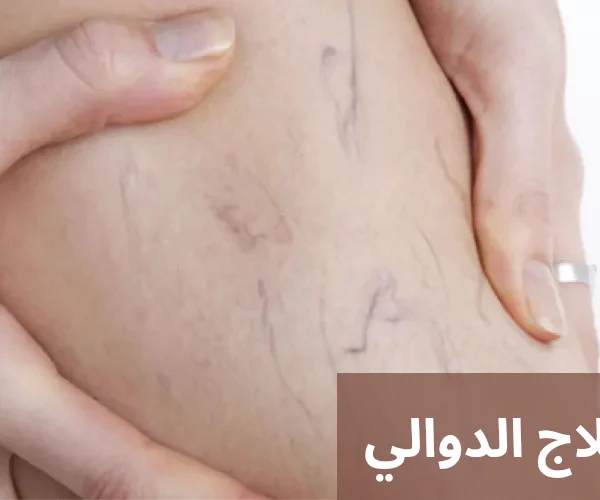 ما هو علاج الدوالي 20250324 214344 0000