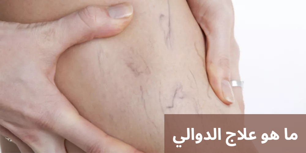 ما هو علاج الدوالي 20250324 214344 0000