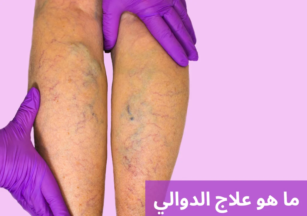 ما هو علاج الدوالي 20250324 214537 0000