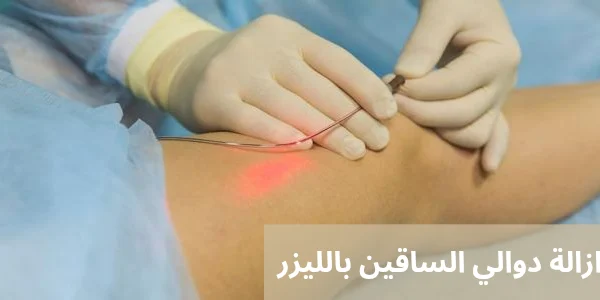 ازالة دوالي الساقين بالليزر 20250409 001723 0000