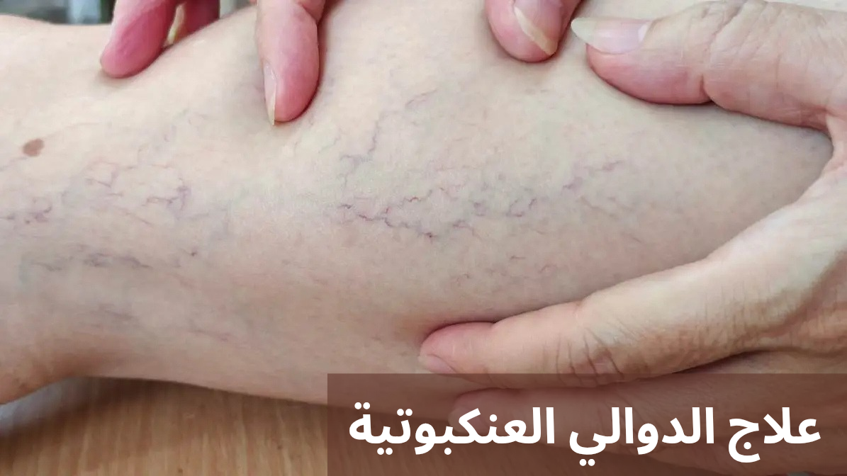 علاج الدوالي العنكبوتية 20250419 025626 0000