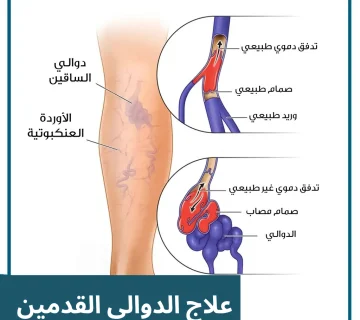 علاج الدوالي القدمين 20250423 004239 0000