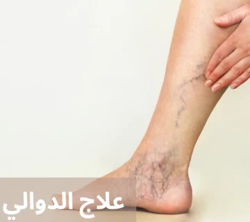 علاج الدوالي المبكر 20250424 005035 0000