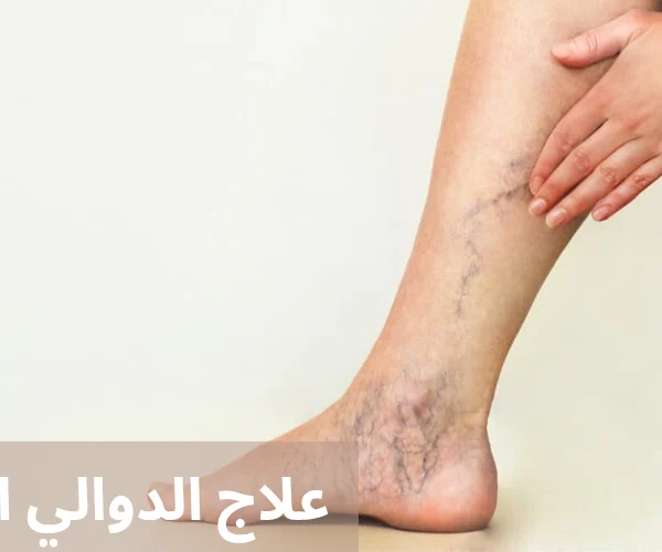 علاج الدوالي المبكر 20250424 005035 0000