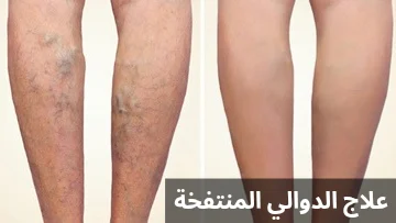 علاج الدوالي المنتفخة 20250426 000728 0000