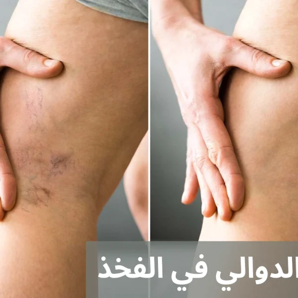 علاج الدوالي في الفخذ 20250501 004722 0000