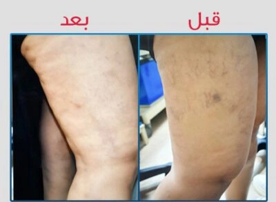 احدث علاج للدوالي