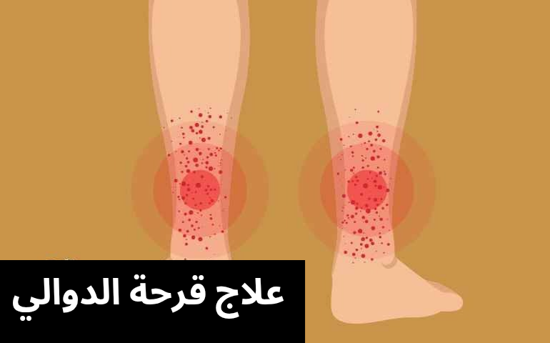 علاج قرحة الدوالي 20250506 020620 0000