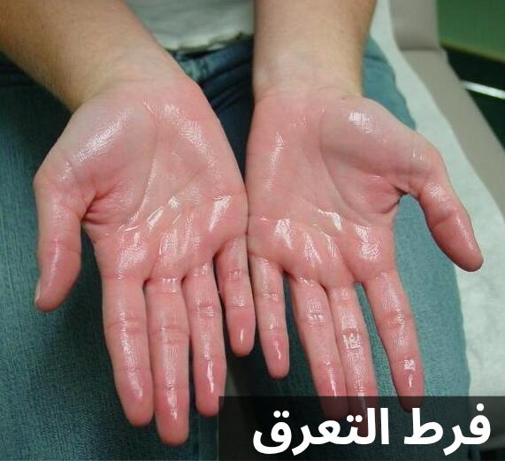 فرط التعرق 20250513 052833 0000