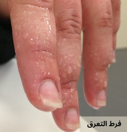 فرط التعرق 20250513 053002 0000