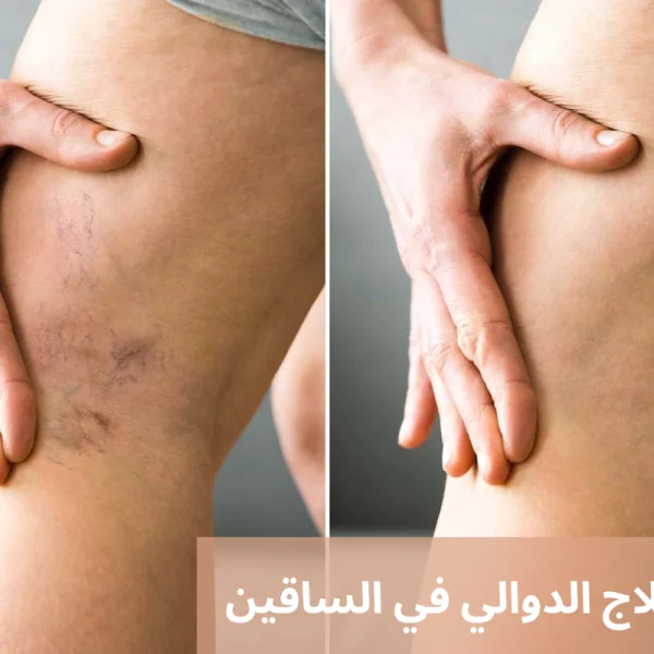 كيفية علاج الدوالي في الساقين 20250510 012516 0000