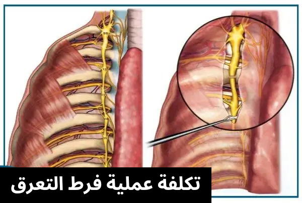 تكلفة عملية فرط التعرق 20250622 024948 0000