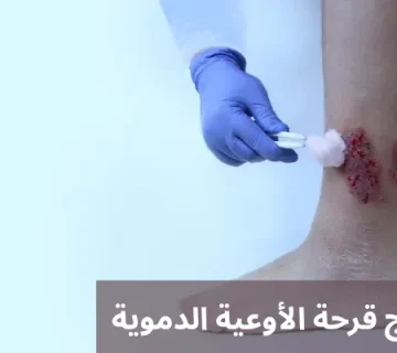 علاج قرحة الأوعية الدموية 20250622 042958 0000